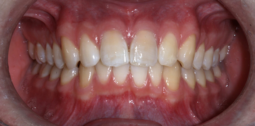 After - Barhill Dental