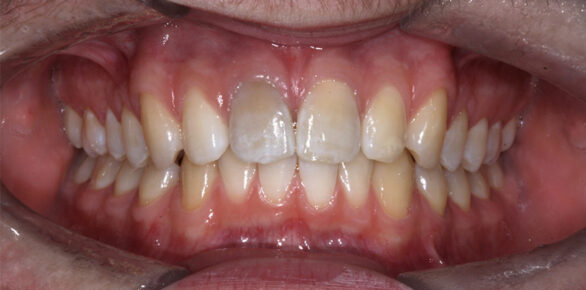 Before - Barhill Dental