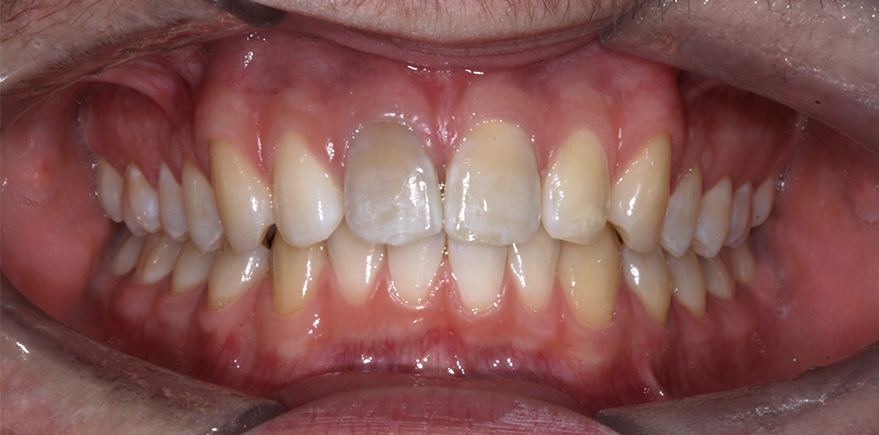 Before - Barhill Dental