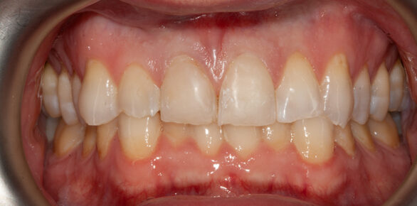 After - Barhill Dental