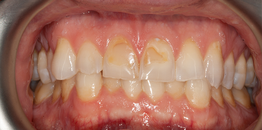 Before - Barhill Dental