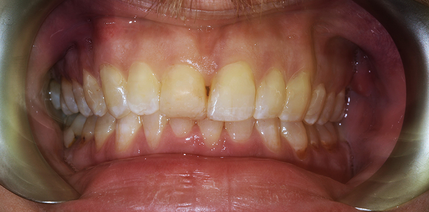 After - Barhill Dental