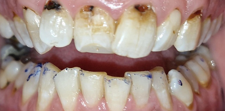 Before - Barhill Dental