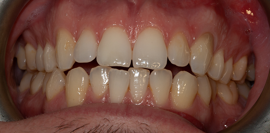 After - Barhill Dental
