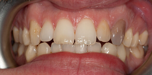 Before - Barhill Dental